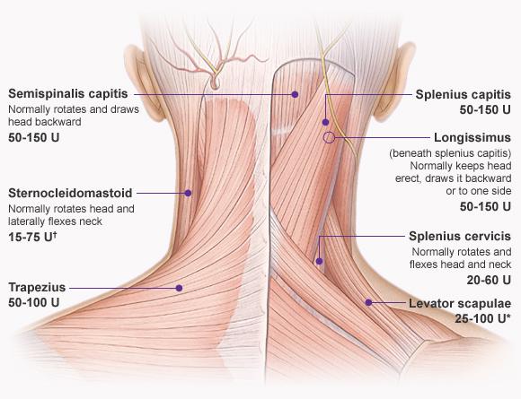 TENSION HEADACHES Guelph Physiotherapy Guelph Rehab Centre