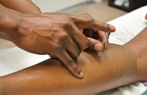 Picture of therapist putting in acupuncture needle